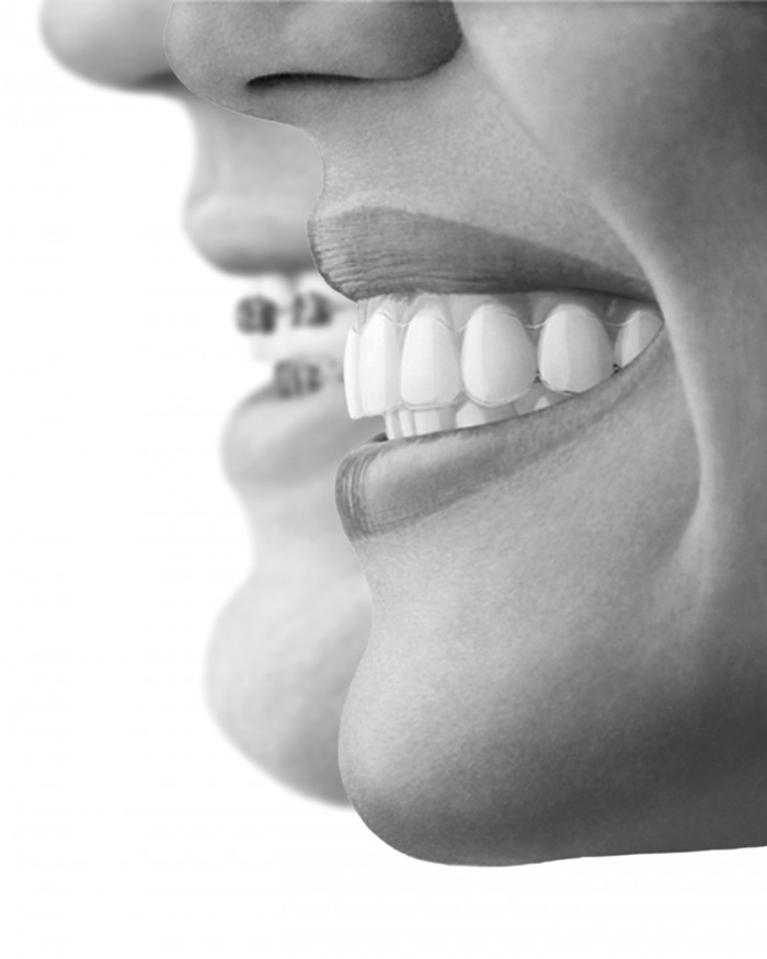 invisalign_bw_profile